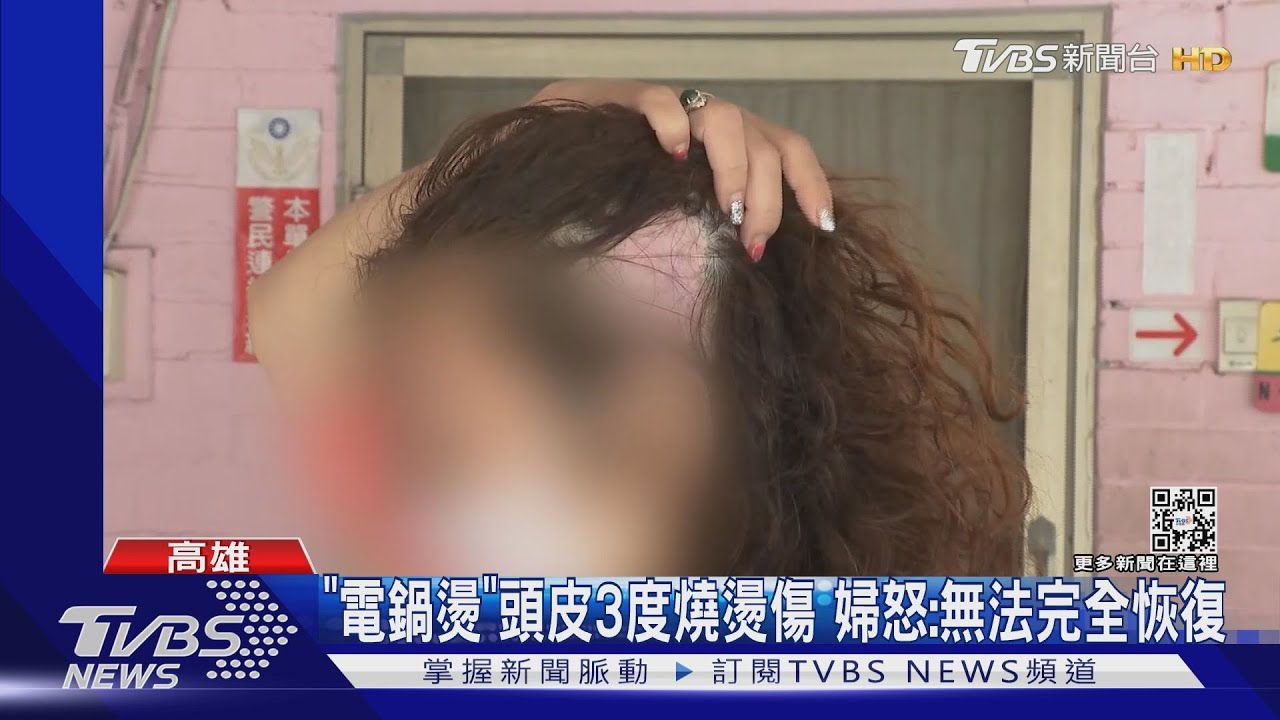 「電鍋燙」婦3度燙傷慘禿頭!設計師仍未賠償 遭判刑7個月