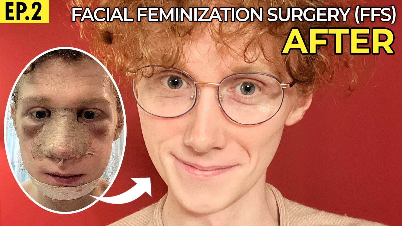 Facial feminization surgery Korea 3 month update facial contouring and rhinoplasty review YouTube video