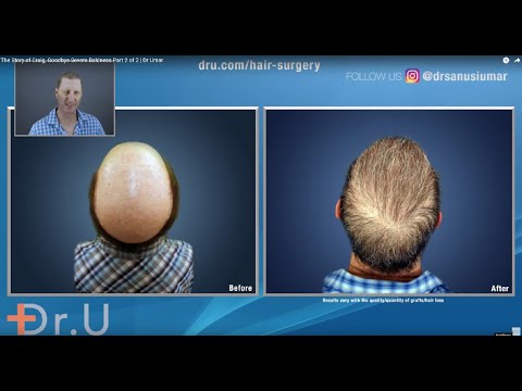 The Story of Craig, Goodbye Severe Baldness Part 2 of...