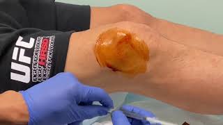 MoraMD: Knee Effusion Aspiration.  A Nearly Painless Technique