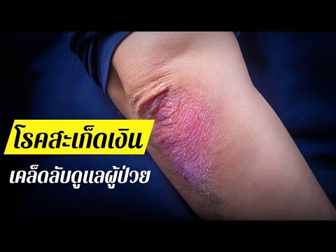 ลบโรคสะเก็ดเงิน พริกไทยทิงเจอร์ของโรคสะเก็ดเงิน