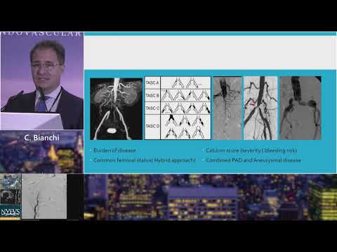 Surgical Therapy in Complex Aorto Iliac Disease   C  Bianchi   PAD Session