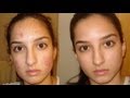 A true miracle- How I got rid of my acne. Daily skin ...