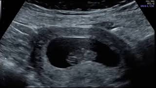 Dating scan - fetal heartbeat