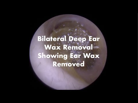 Quick Ear Wax Removal 2 Ears In Under 2 Mins - Ep 15