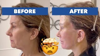 Incredible Full Omakase Facelift Results on a 63 Year Old!