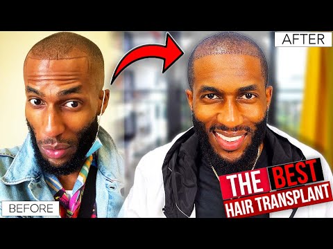 The BEST Black-Afro Hair Transplant in the WORLD! |...