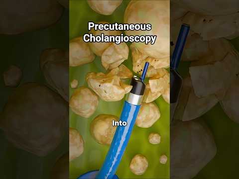 How Do Doctors Remove Gallbladder Stones Without Surgery?