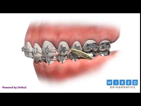 How Elastics are Used to Treat a Class II Malocclusion
