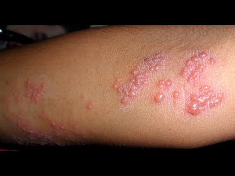 Metode potensi populer pengobatan Anggota berdiri sedikit sperma
