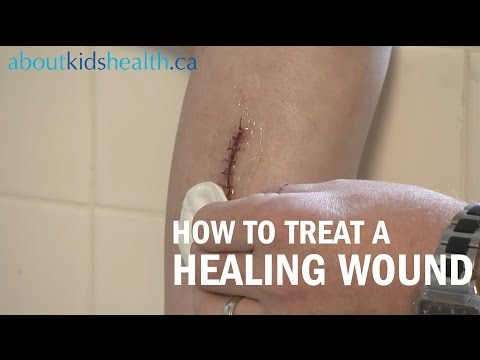 How to care for a healing wound | AboutKidsHealth at The Hospital for Sick Children