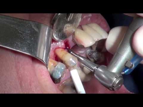 Immediate Dental Implant Upper Premolar - Explicit