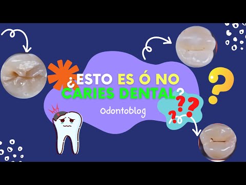 ¿Esto es ó no es Caries dental?