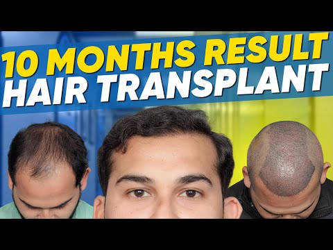 Hair Transplant in Berlin | Best Results & Cost of...