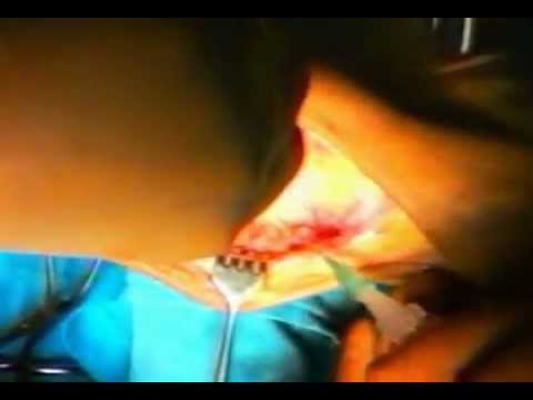 Allungamento osteocondrosi Tintura con castagne vodka sulle giunzioni