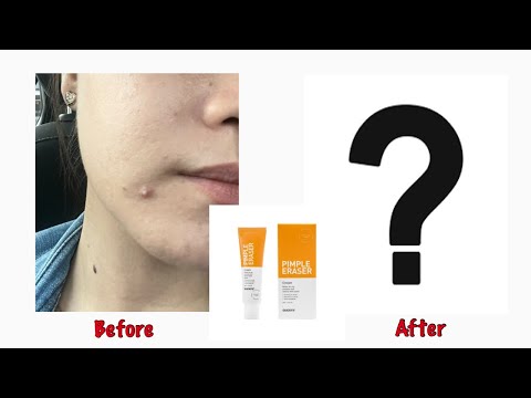 Pimple Eraser Cream by QuickFx | Result after 7 days | 2022