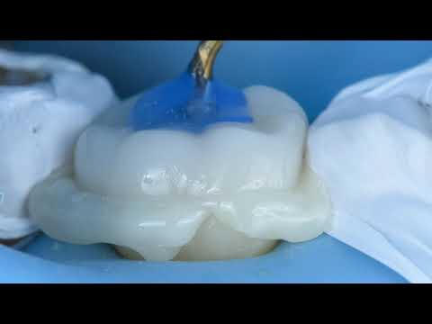 Ceramic EMax Overlay  - All Steps And All Tips And Tricks From Prep To Delivery