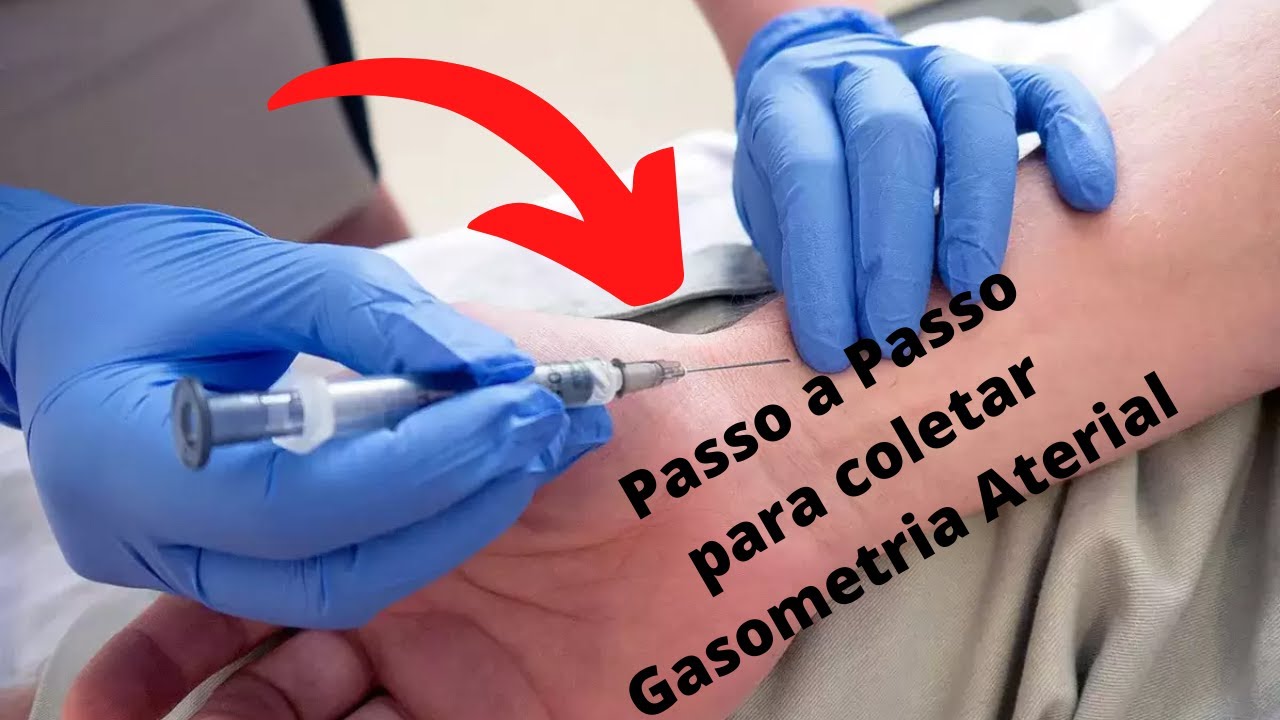 Coleta de gasometria ou Punção Arterial