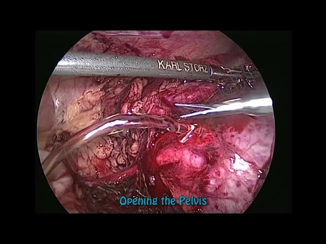 Výslovnost videa pyelography v Anglický