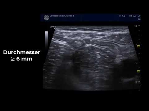 Sonography of a normal appendix and criteria for appendicitis