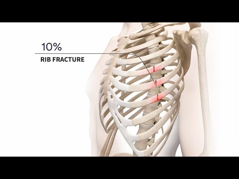 Behandlung akuter und chronischer Rippenfrakturen