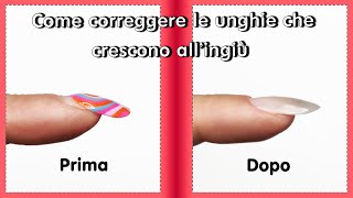 Come correggere le unghie ad UNCINO | Unghie che crescono all'ingiù | ONICOGRIFOSI