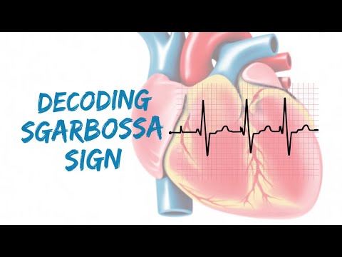 #LBBB with #MI #ecg changes #Sgarbossasign