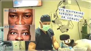 Eye Whitening Surgery by Dr. Soroudi, MD, MS