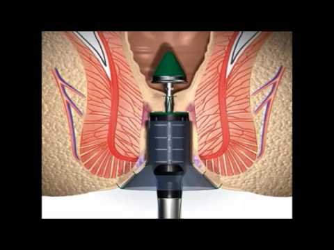 Ethicon pph03 hemorrhoidal stapler