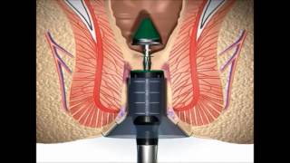Stapled Haemorrhoidectomy using the PPH System - English