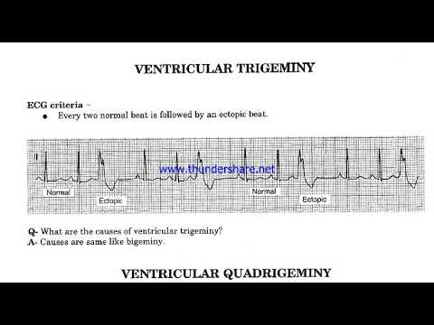 Ventricular Bigeminy, Trigeminy & Quadrigeminy