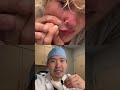 Dr. Sugai Reacts: Home Pimple Extraction!