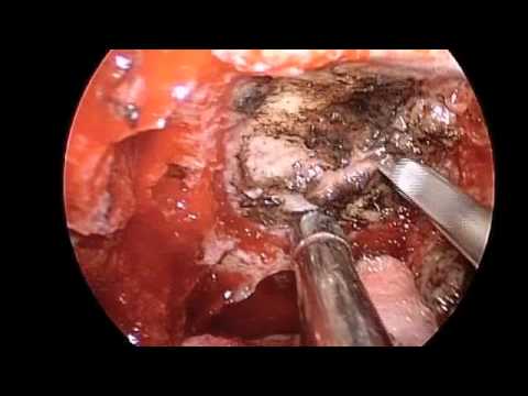 Endoscopic Removal of Olfactory Meningoma