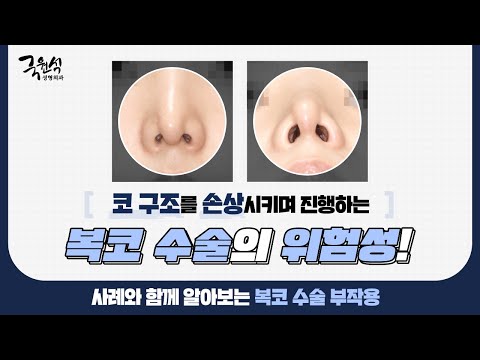 #복코수술 부작용 및 해결 방법! 그에 대한 실제사례, 같이 살펴봐요!