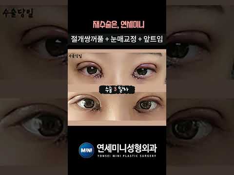 쌍꺼풀 재수술 찐후기
