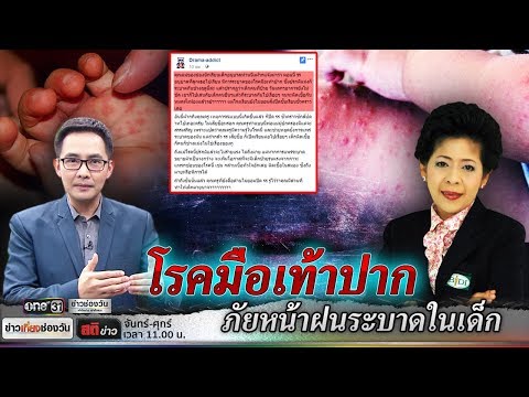 ครีมโรคสะเก็ดเงินชี่กง basyuan ผู้สำเร็จการศึกษา ครีมโรคสะเก็ดเงินมีประสิทธิภาพมากที่สุด