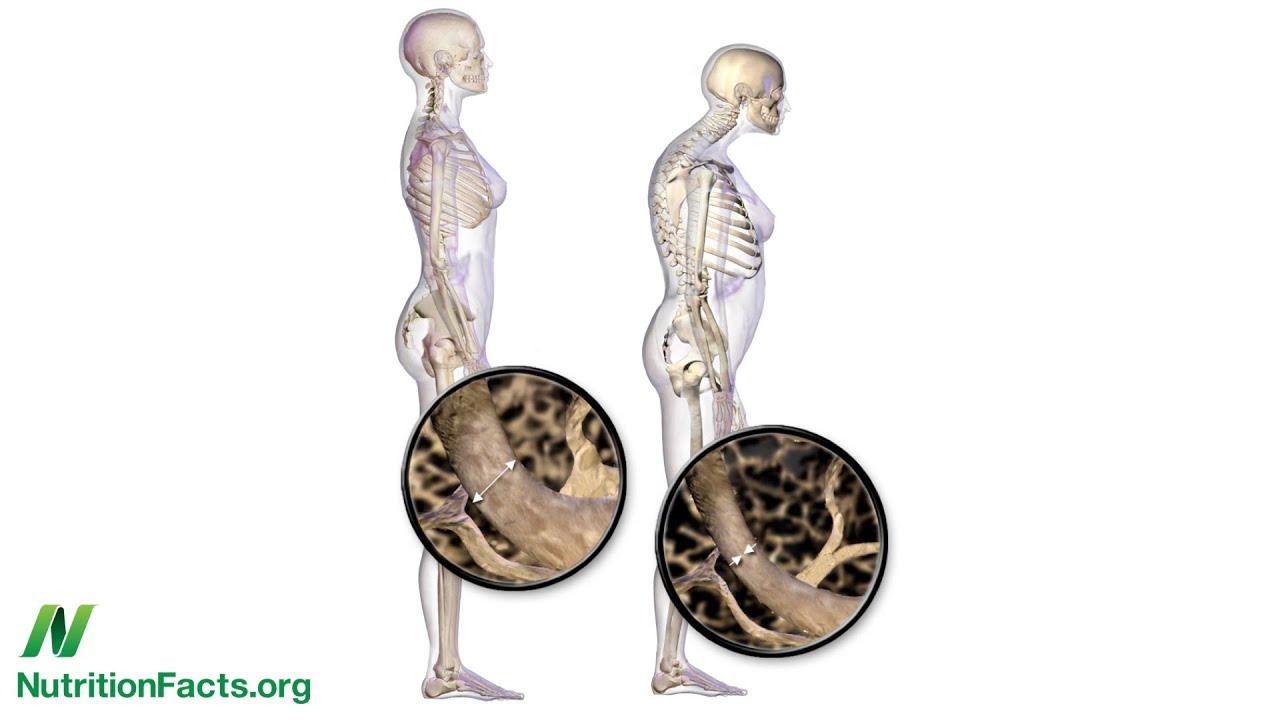 Alkaline Diets, Animal Protein, and Calcium Loss