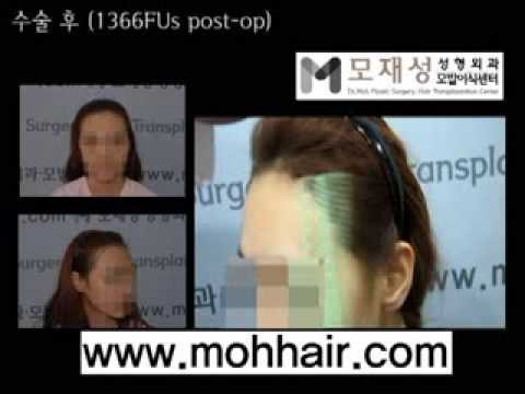 Female hairline correction by Dr. Moh