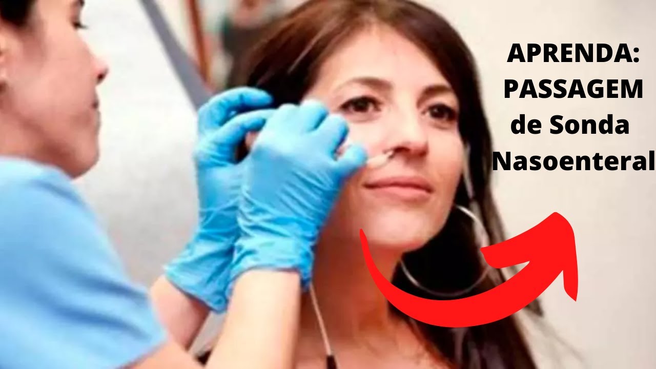 Como passar Sonda Nasoenteral (SNE) ou Nasogastrica (SNG) ?