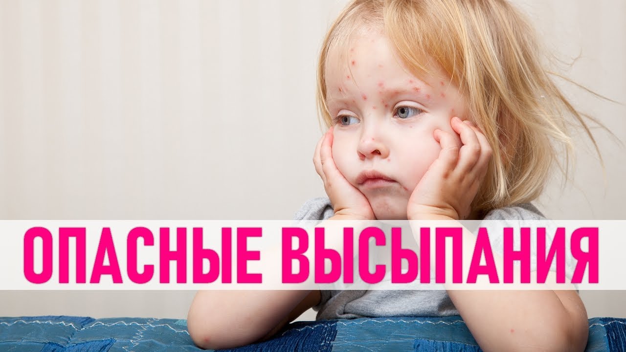 ВЫСЫПАНИЯ НА ДЕТСКОЙ КОЖЕ | Разбираемся в детской сыпи