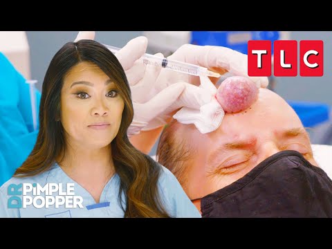 Most Frustrating Forehead Growths | Dr. Pimple Popper | TLC