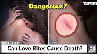 Can Love Bites Cause Death?