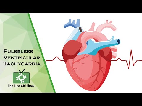 Pulseless Ventricular Tachycardia