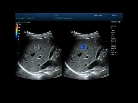 STE (Sound Touch Elastography) STE (Sound Touch Elastography)