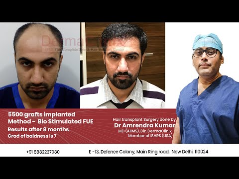 5500 Grafts Hair Transplant Surgery Result after 8 months by Dr Amrendra Kumar