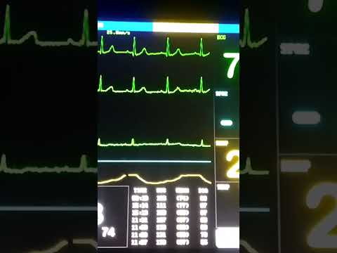 multi parameters patient monitor shart video clip/