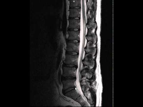 intervertebralis arthrosis hogyan kell kezelni