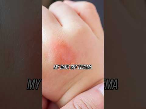 Is your baby's eczema potentially linked to a hidden food allergy? #babyeczema #allergies