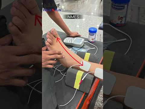 Neuromuscular electrical stimulation for faster recovery. #physiotherapist #physio