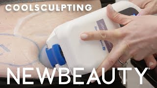 Does CoolSculpting Work? Exactly What to Expect From the Fat Freezing Treatment.